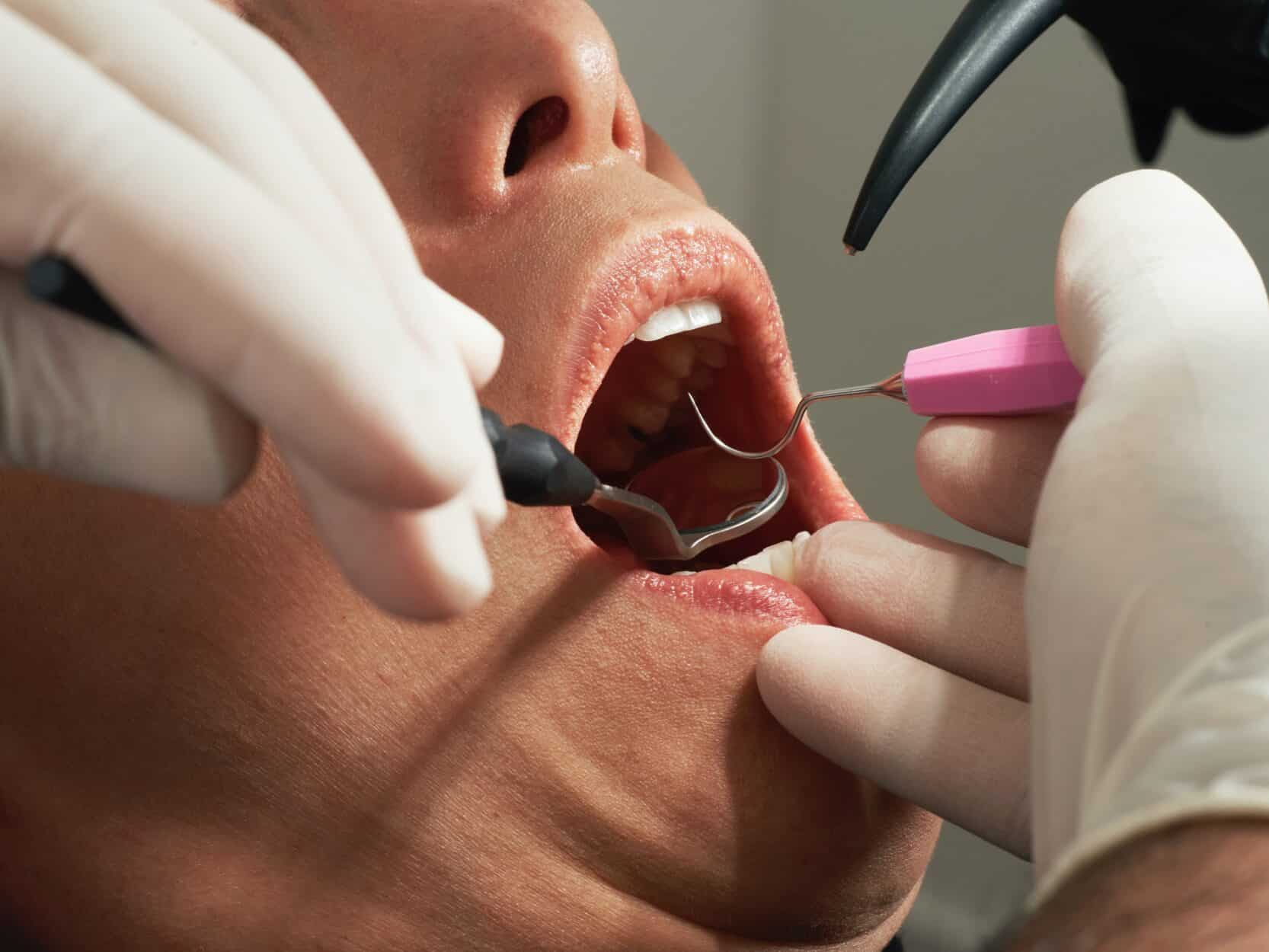 Dental Damage